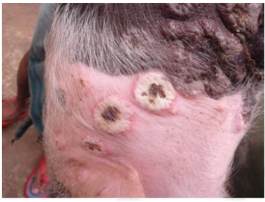 Whitish pustular growth